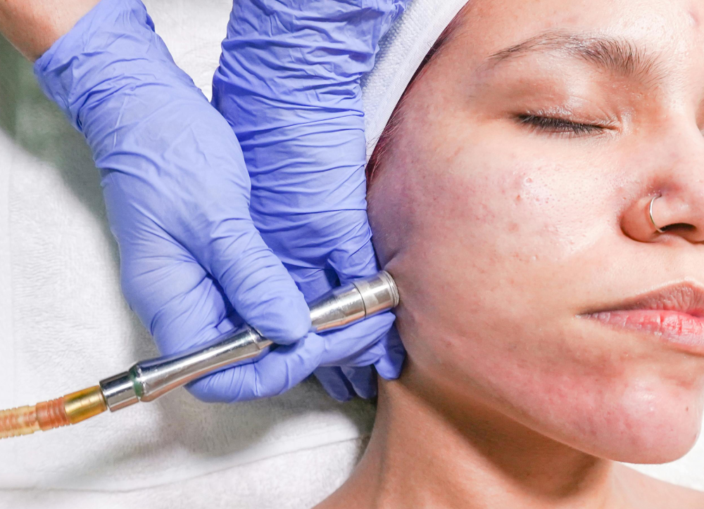 Microdermabrasion
