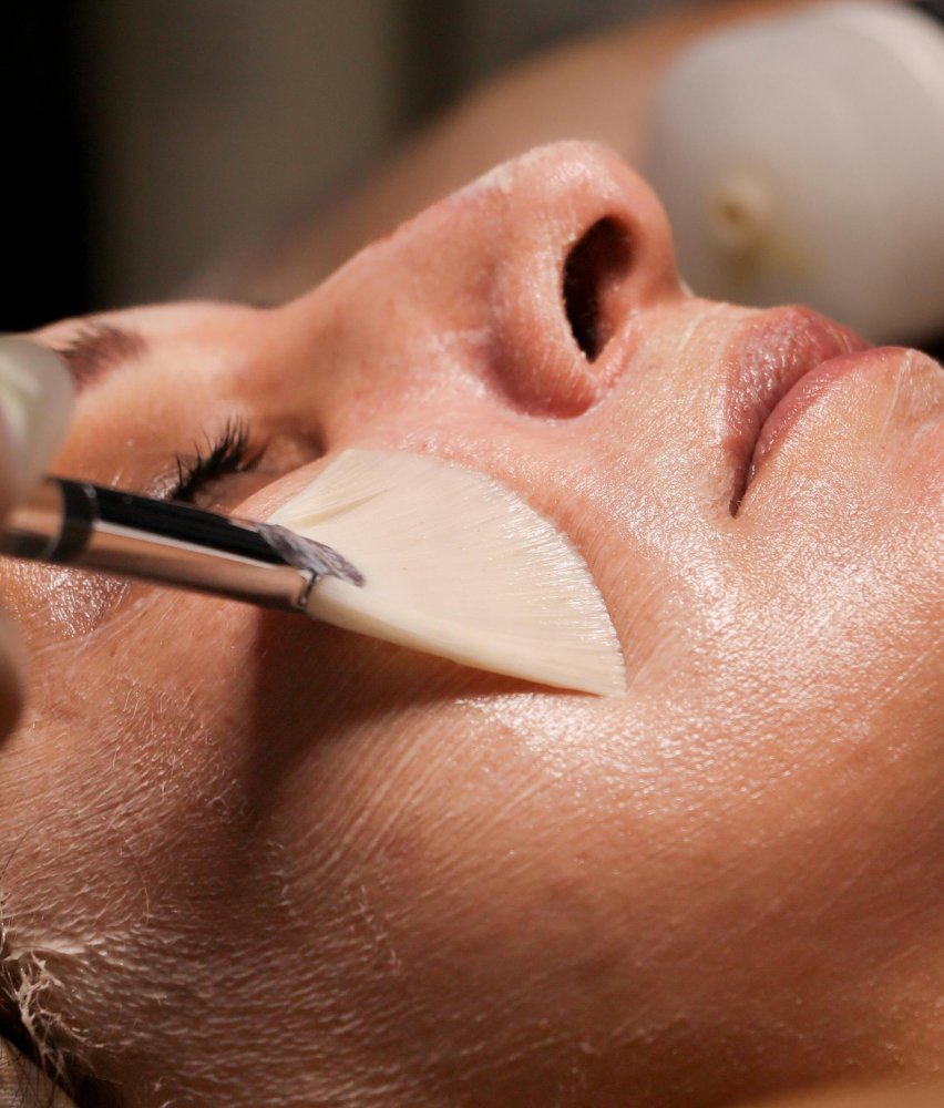 Chemical Peels